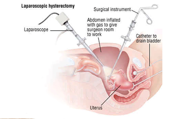 Hysterectomy