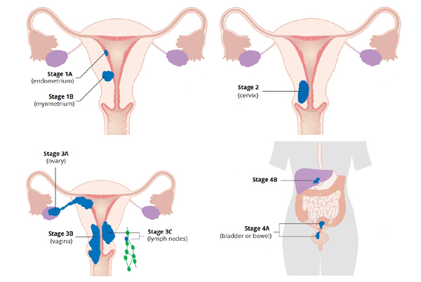 Uterine Cancer Surgery