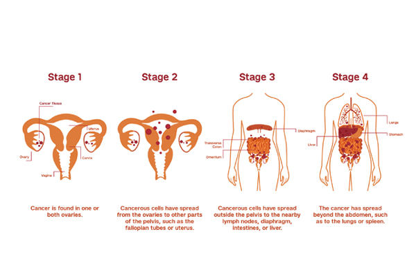 Ovarian Cancer Surgery