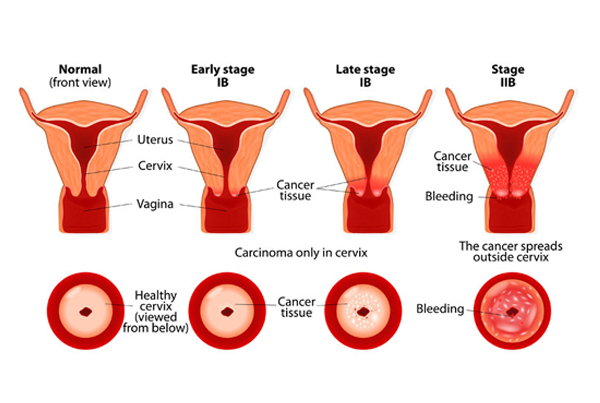 Cervical Cancer Surgery