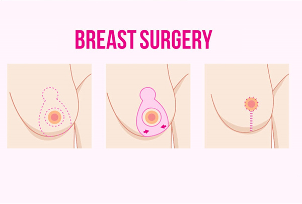 Breast Surgery