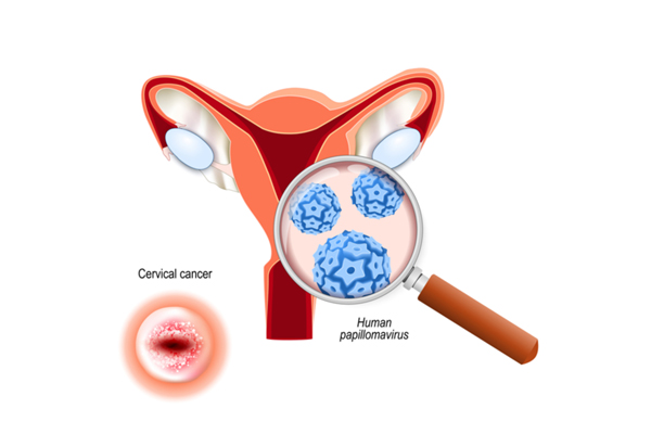 Cervical Cancer Screening