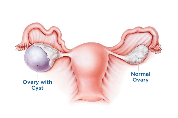 Ovarian Cyst Surgery