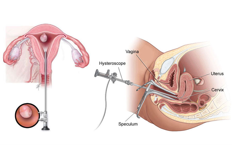 Hysteroscopy