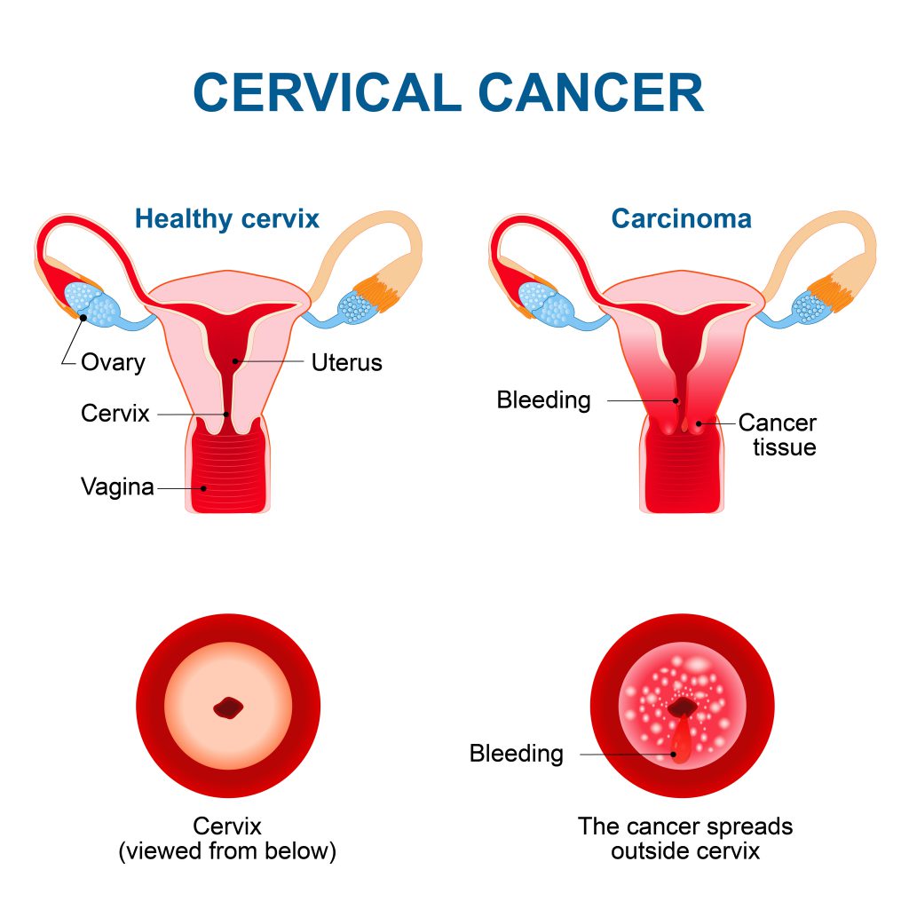 CERVICAL CANCER VACCINE