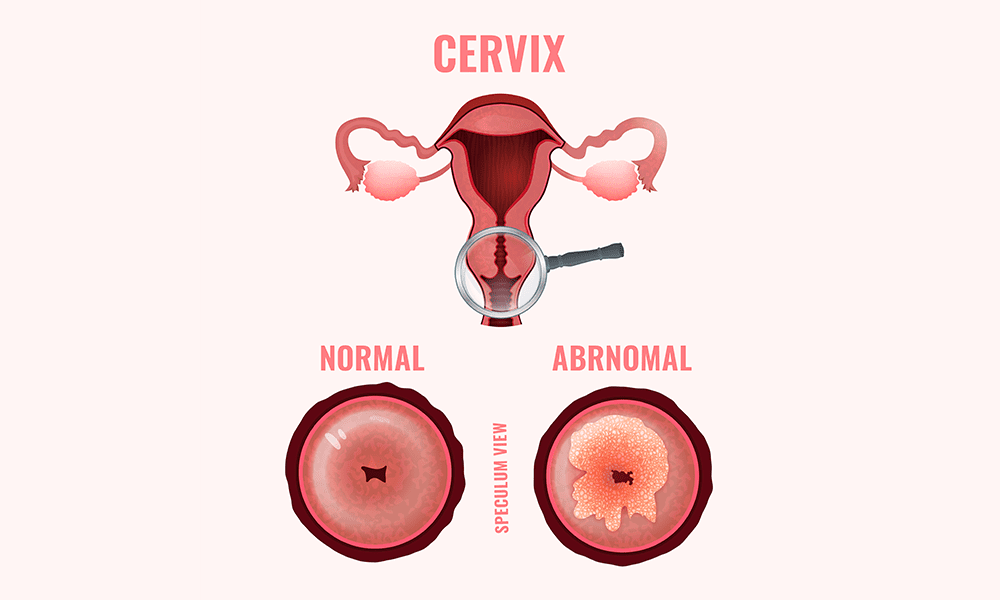 CERVICAL CANCER VACCINE