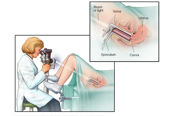 doctor for colposcopy