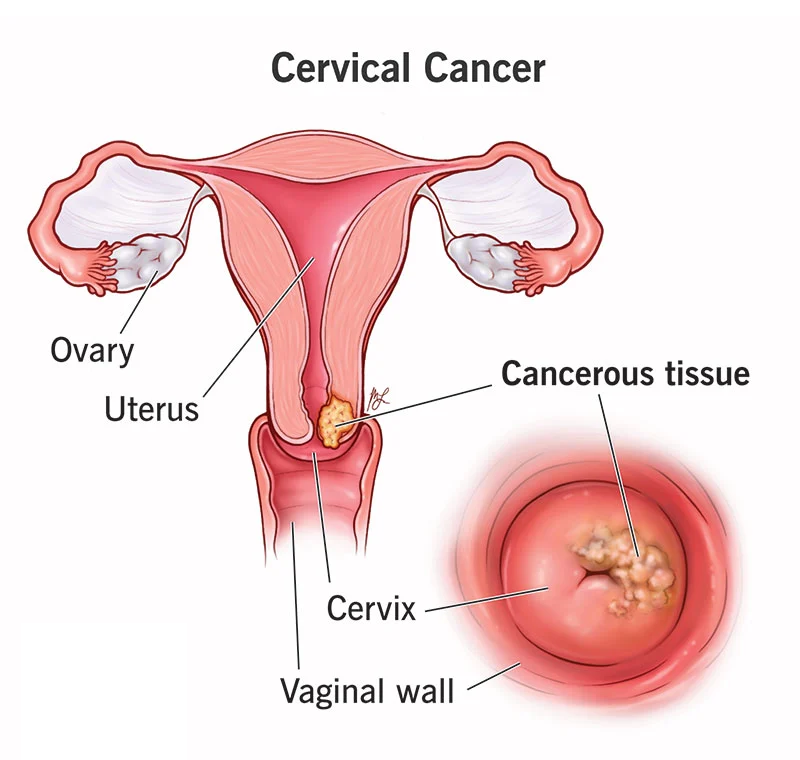 BEST CERVICAL CANCER SURGEON