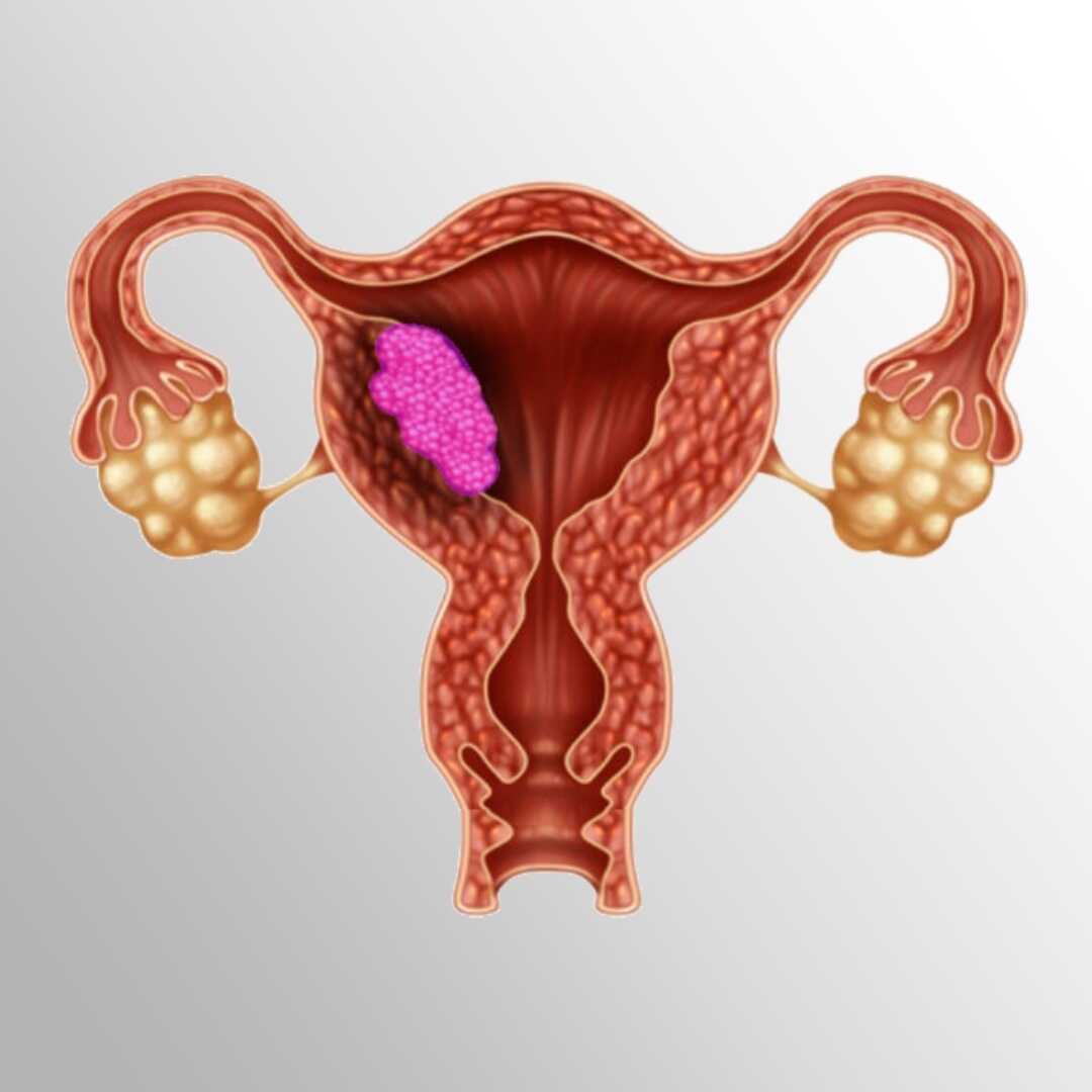 UTERUS CANCER TREATMENT