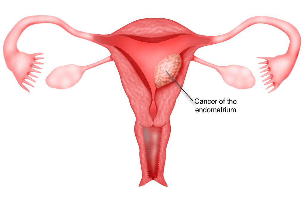 UTERUS CANCER TREATMENT