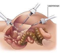 Best Laparoscopic Cancer Surgeon